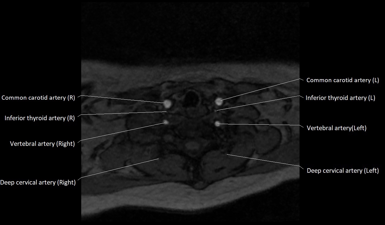 Carotid artery anatomy axial 3T image 59.jpg